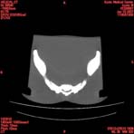 PBU CT Scan Torso Slice