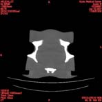 PBU CT Scan Torso Slice