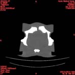PBU CT Scan Torso Slice