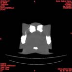 PBU CT Scan Torso Slice