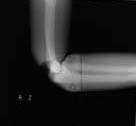 PBU-50 X-ray Elbow Scan