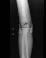PBU-50 X-ray Knee Scan
