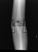 PBU-50 X-ray Knee Scan