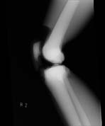 PBU-50 X-ray Knee Bent Scan