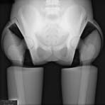 PBU-50 X-ray Pelvis Scan