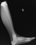PBU-50 X-ray Leg and Foot Scan