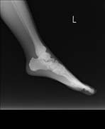 PBU-50 X-ray Foot Bent Scan