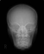PBU-50 X-ray Head Front Scan