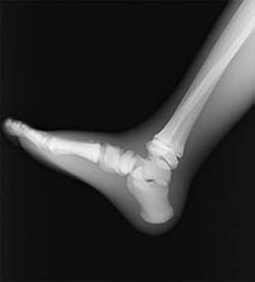 PBU-70 Foot Side View X-Ray