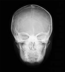 PBU-70 Skull Front View X-Ray