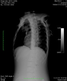 PBU-70 Lateral Chest X-Ray