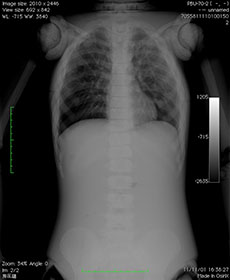 PBU-70 AP/PA Chest X-Ray