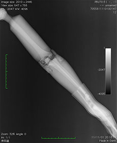 PBU-70 Arm With Elbow Extended X-Ray