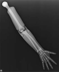 PBU-70 Arm with Elbow Extended 2 X-Ray