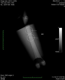 PBU-70 Thigh with Pathologies X-Ray