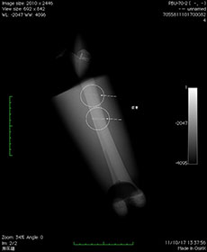 PBU-70 Thigh with Pathologies X-Ray