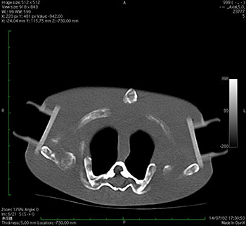 Whole Body Newborn Baby Phantom - CT Image 1