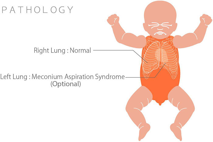 Whole Body Newborn Baby X-Ray Phantom