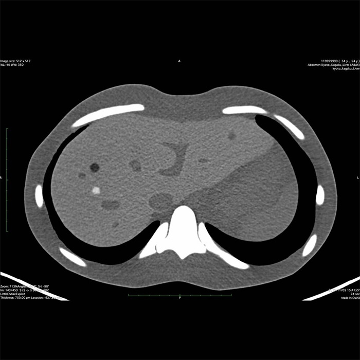 Dual Modality Human Abdomen Phantom (CT, Ultrasound) - US-22 - Kyoto Kagaku - CT
