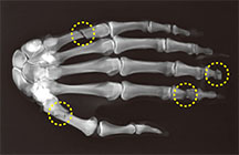 Fractured hand and forearm x-ray 1