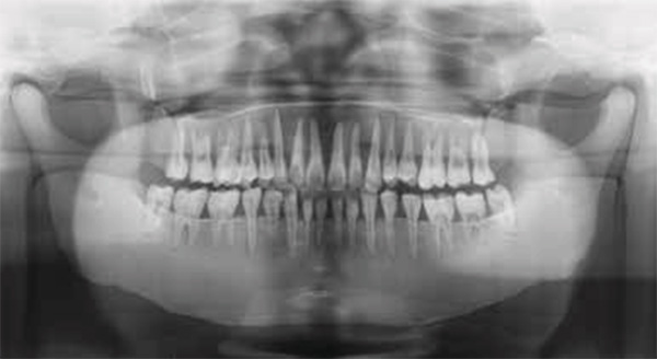 Dental Radiography Head Phantom - PH-47 - Kyoto Kagaku