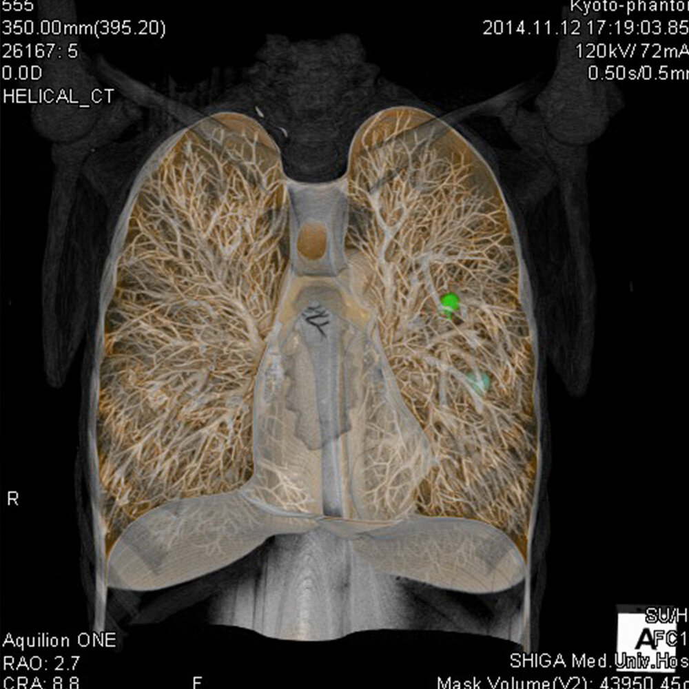 CT image of a PH-58 subsolid nodule attached within the N-1 LUNGMAN