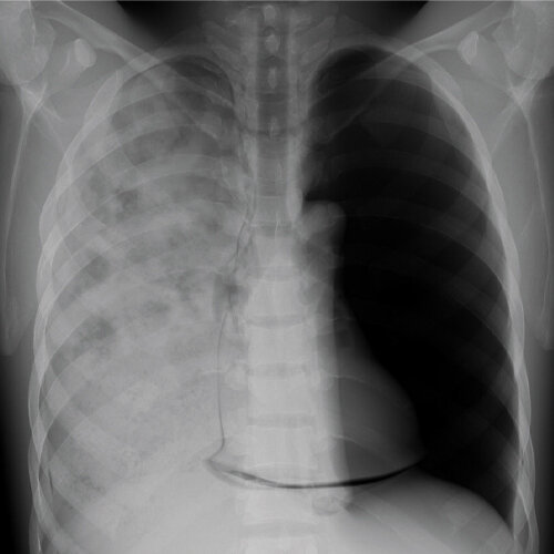 Radiographic image produced with the LUNGMAN Pneumonia Module