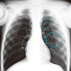 Bone Fracture Pediatric Phantom - PBU-70B - Kyoto Kagaku - Chest X-ray