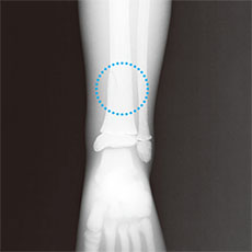 Bone Fracture Pediatric Phantom - PBU-70B - Kyoto Kagaku - Leg X-ray