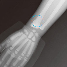 Bone Fracture Pediatric Phantom - PBU-70B - Kyoto Kagaku - Wrist X-ray
