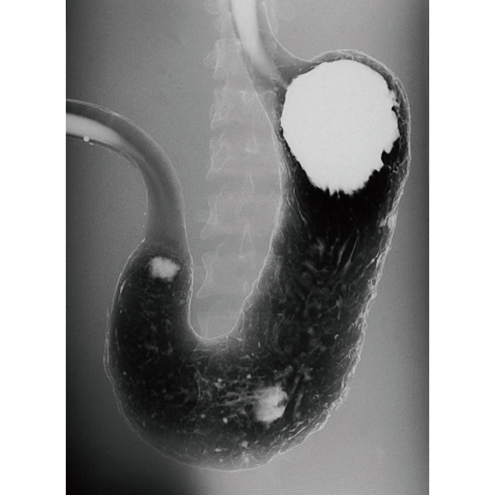 PH-18 stomach phantom image with barium contrast