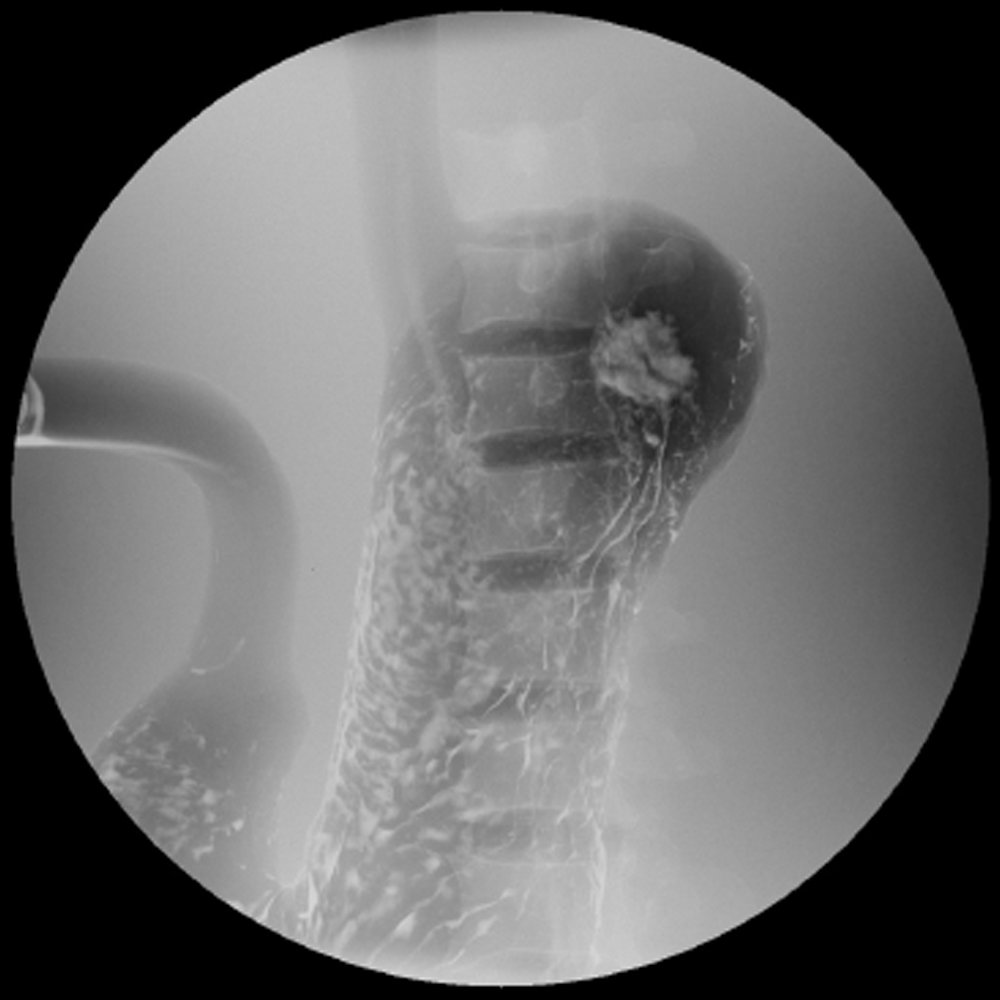 PH-18 stomach phantom fluoroscopic image
