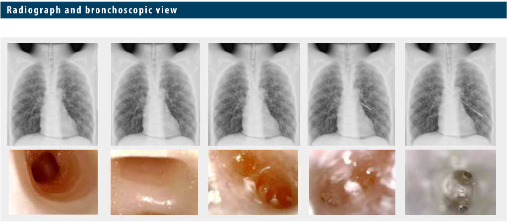 PH-1D radiograph and corresponding bronchoscopic views