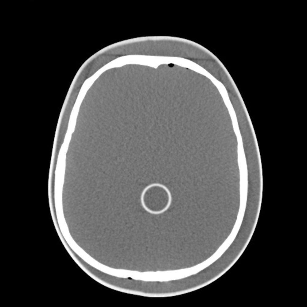 PH-34 CT image with simulated tumor sphere