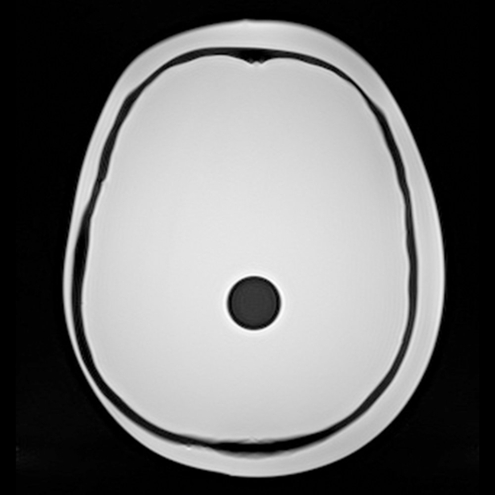 PH-34 MRI image with simulated tumor sphere