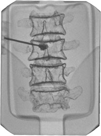 Lumbar Spine Fluoroscopy Training Phantom - Kyoto Kagaku - PH-51