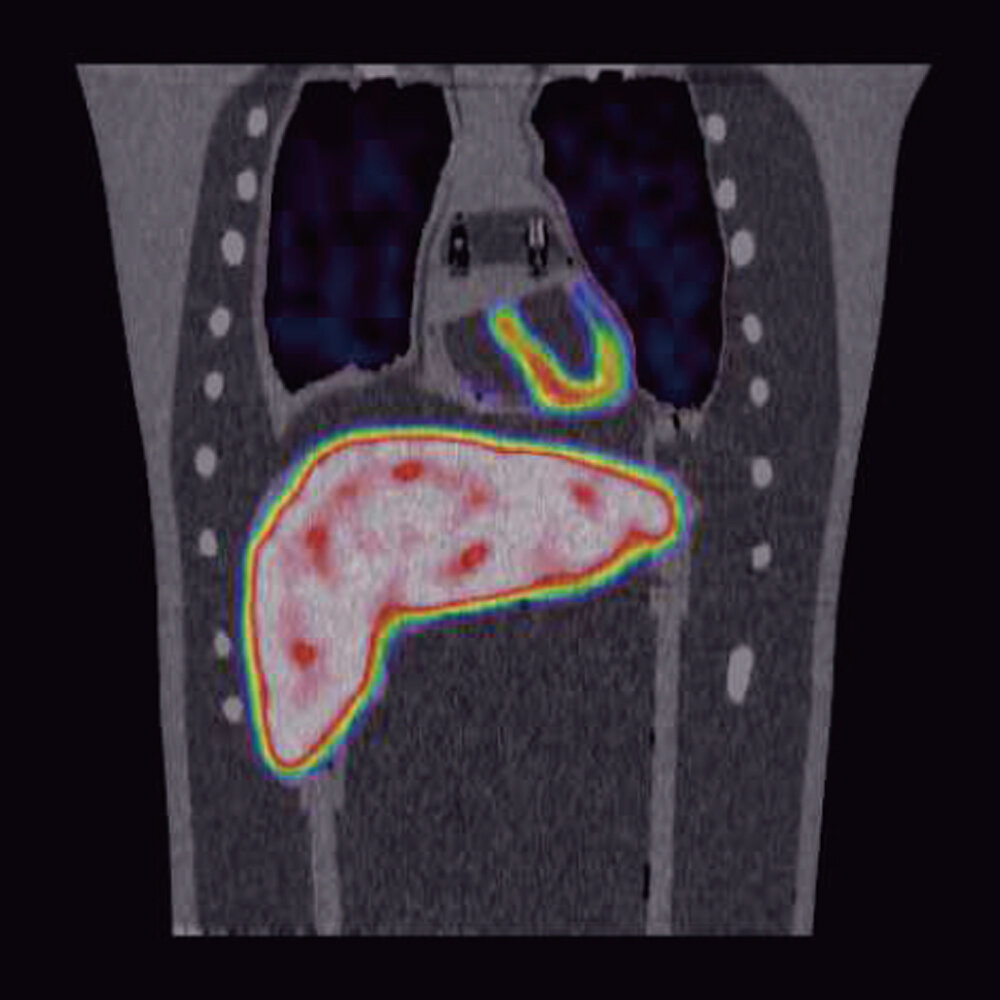 PH-63A PET and CT liver imaging with simulated tumors