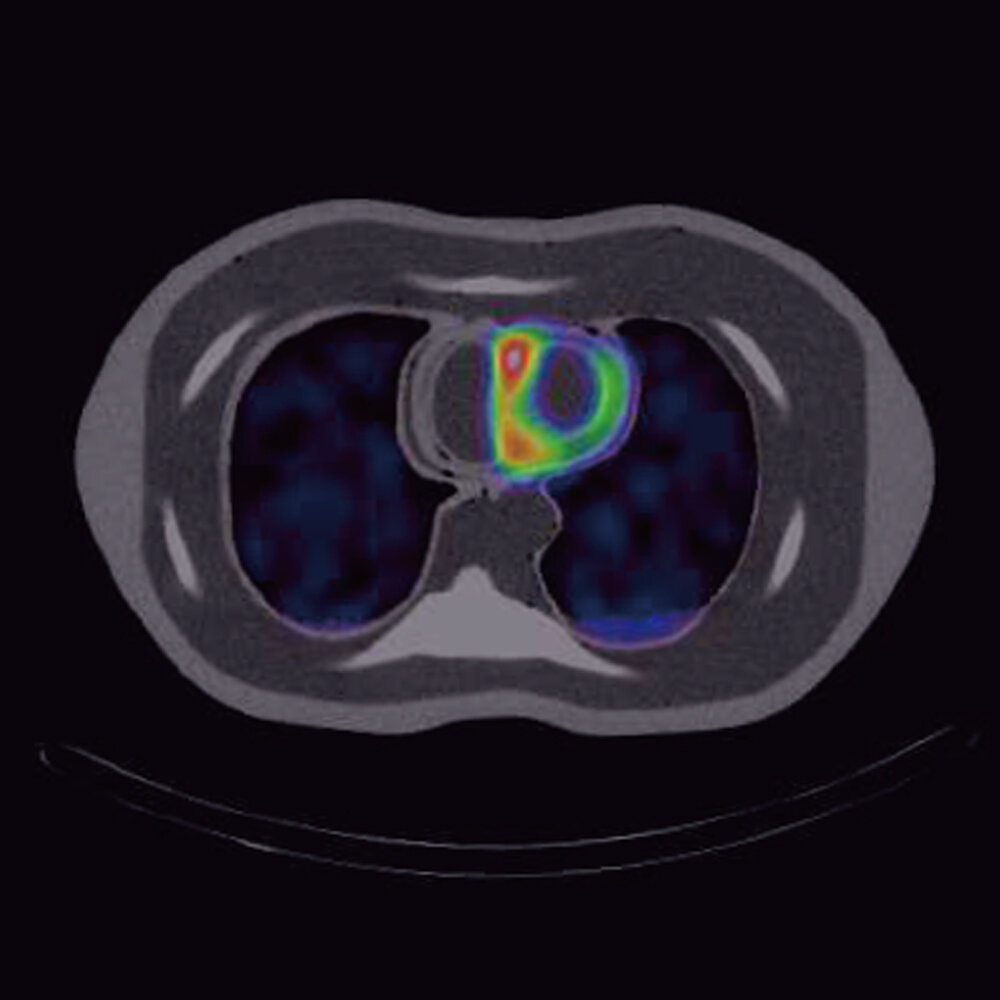 PH-63A SPECT myocardial imaging