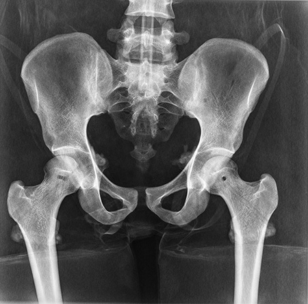 Erler Zimmer Natural Bone Full Body X-Ray Phantom - 7200 - xray 3