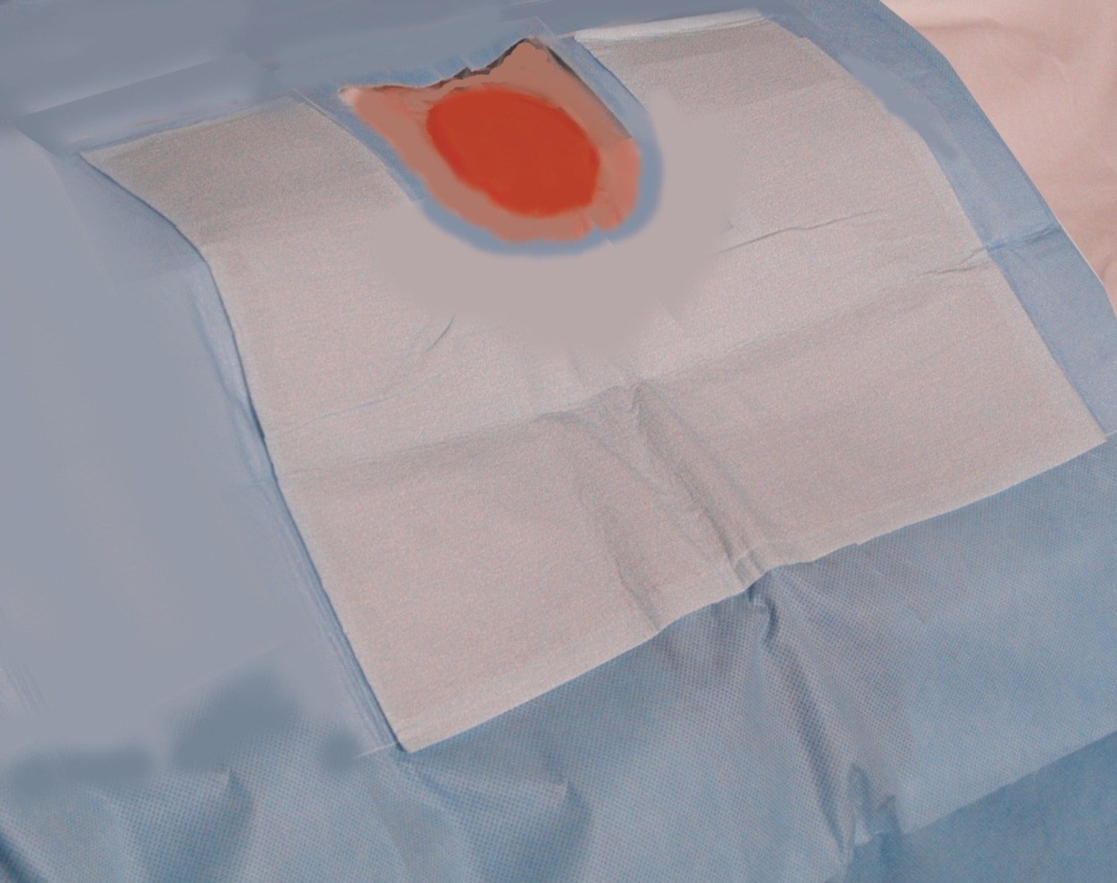 D-120 LeadFree™ Brachial Drape 12″x17″