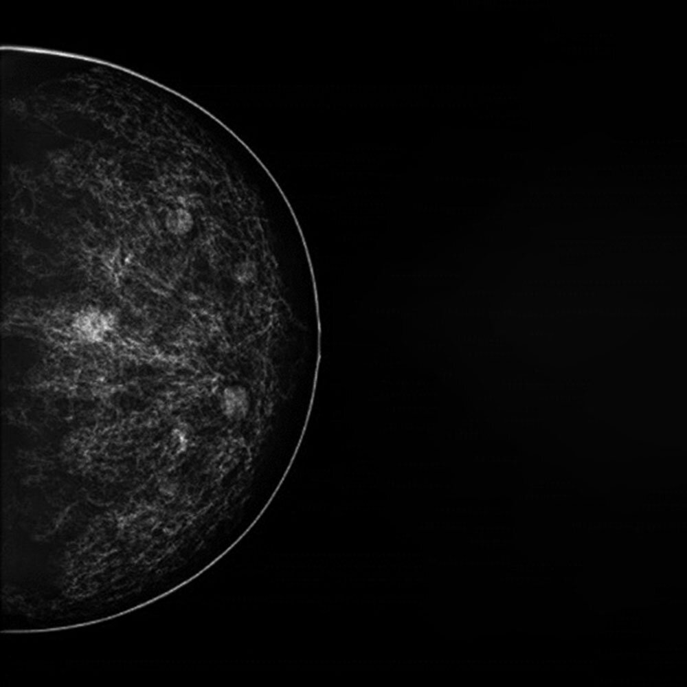 PH-83 mammography image showing simulated structures