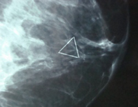 Lesion Marker Scan Image