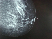 Nipple Marker Scan Image