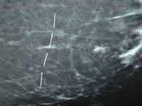 Scar Marker Scan Image