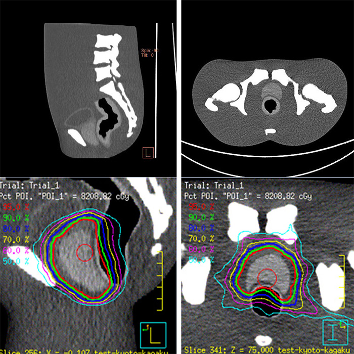 CT Prostate Phantom - PH-46 - Kyoto Kagaku - CT Images