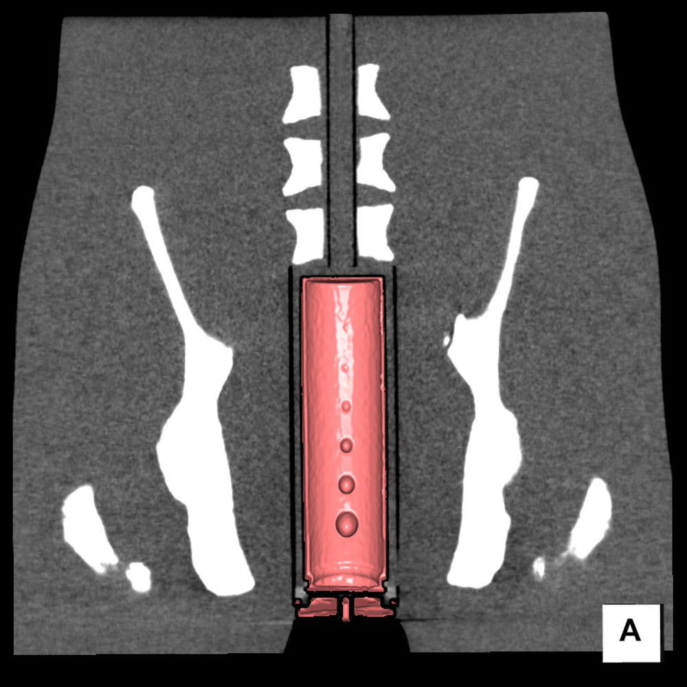 PH-49 CT image with colon unit positioned in the lower torso phantom