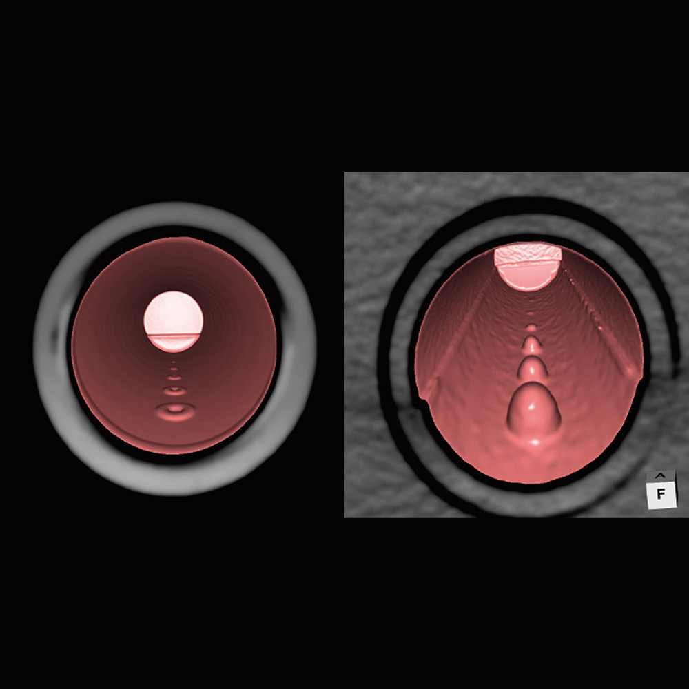 PH-49 virtual endoscope views of depressed and projection targets
