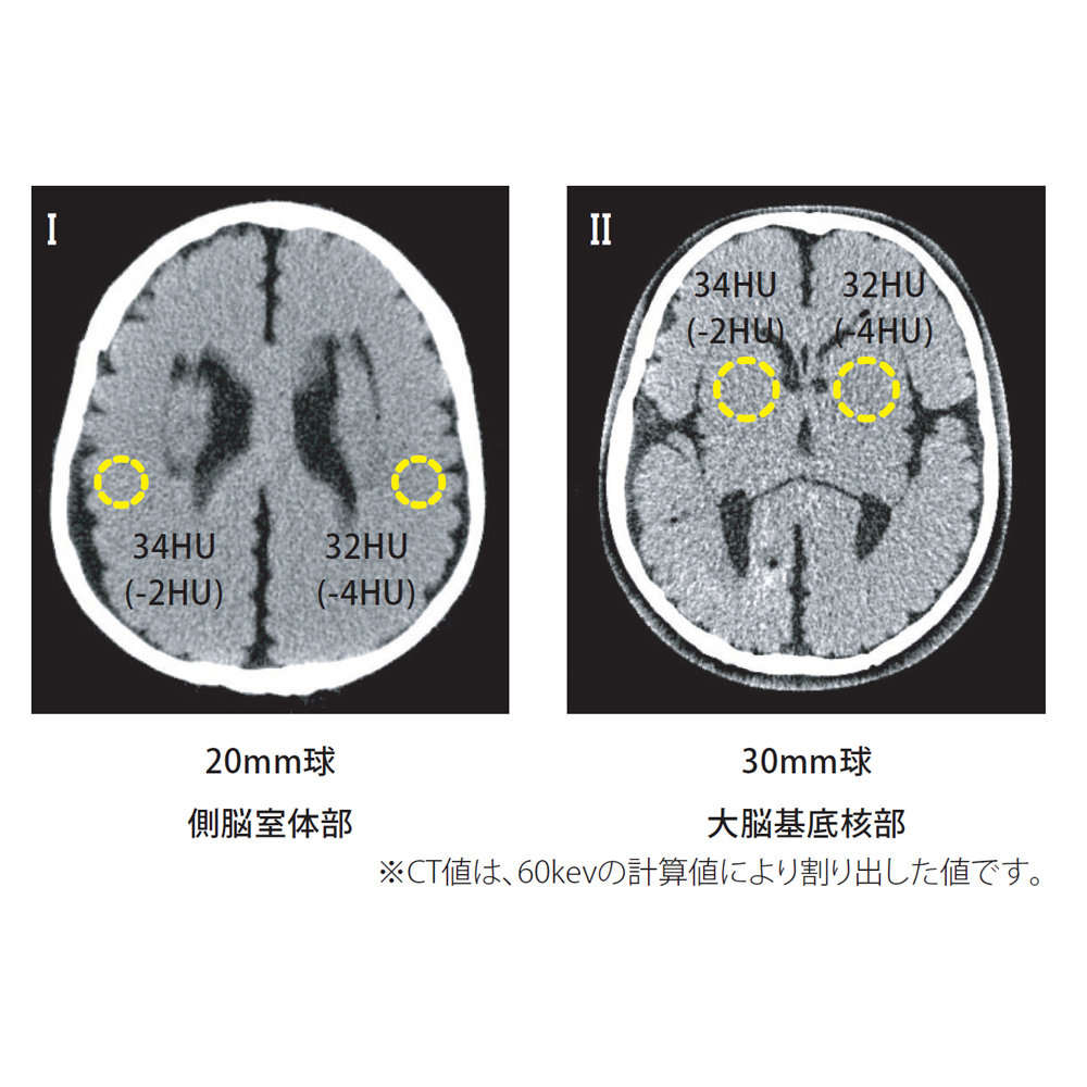 PH-77 CT images showing 20 mm and 30 mm low-contrast simulated stroke lesions