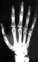 Gentle Slope Hands X-Ray