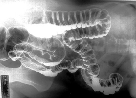 Octostop Little Prism x-ray image